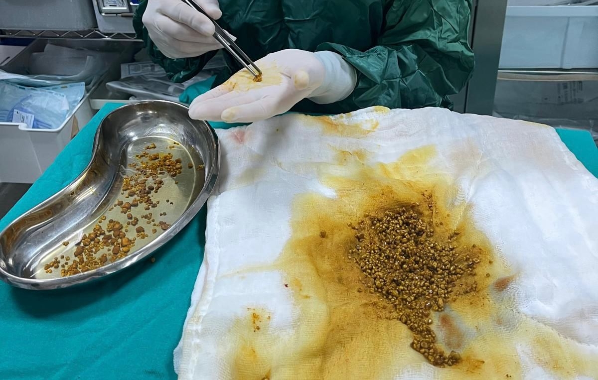Karın Ağrısıyla Gitti, 2 Bin 67 Taşla Döndü