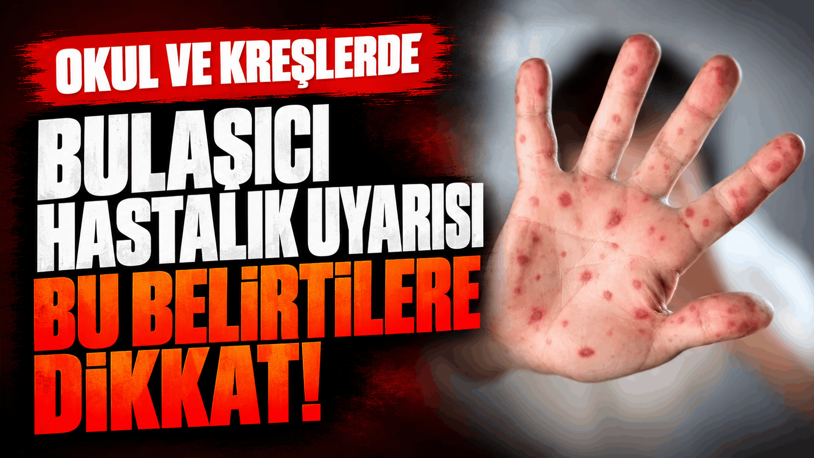 Çocuklarda Ağız Yaraları ve Döküntü Alarmı!